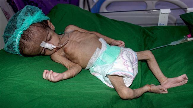 LSM: 3.600 Anak Yaman Tewas, 800 Cacat dan 400.000 Kurang Gizi Akibat Agresi Saudi